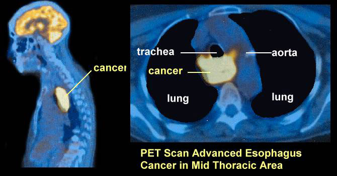 PET-CT SCAN