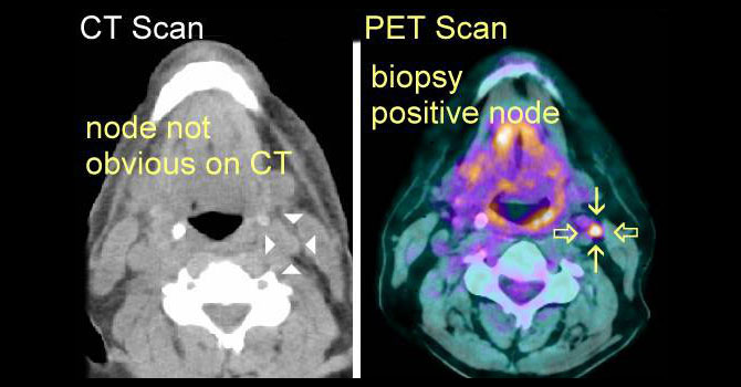 PET-CT SCAN